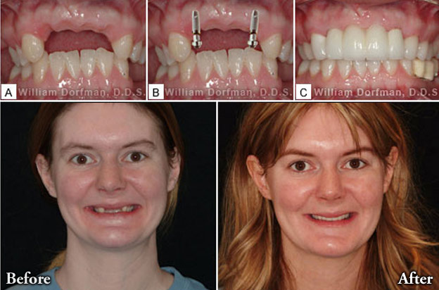 Dr Bill Dorfman Dds Century City Aesthetic Dentistry Dental Bridges | Dr. Bill Dorfman, DDS - Century City Aesthetic Dentistry