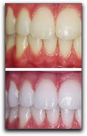 Dazzling White Teeth in Los Angeles