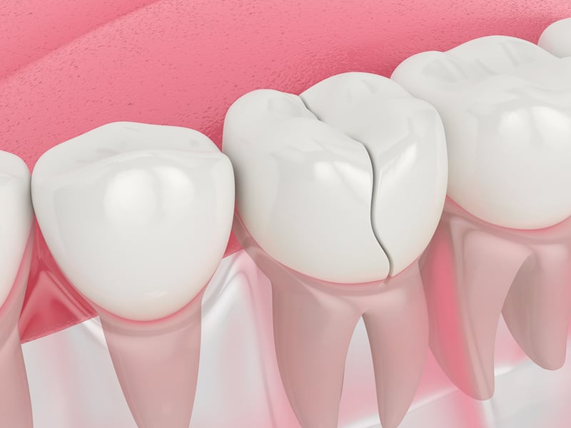 cracked tooth repair Los Angeles