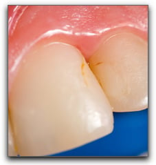 Brush Up On Your Cavity Basics Beverly Hills