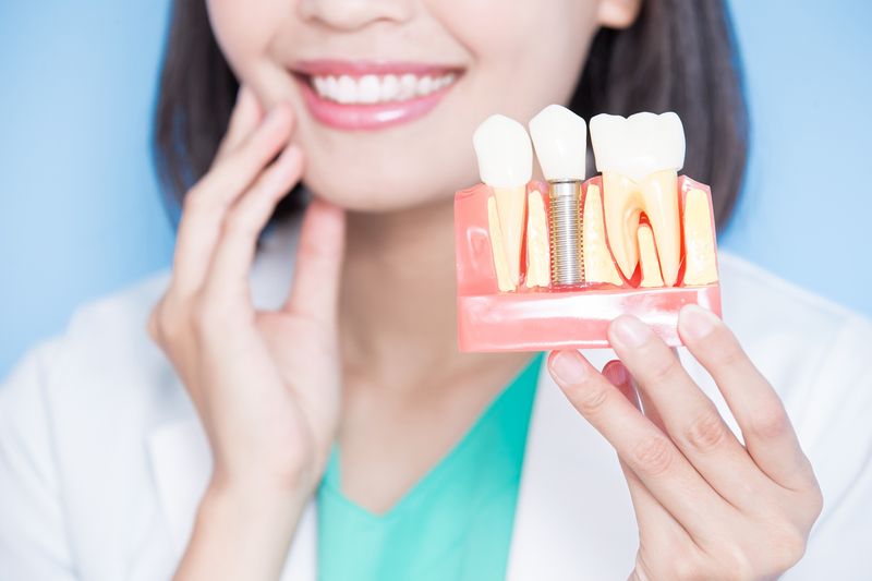 Dental Implants Visual Model