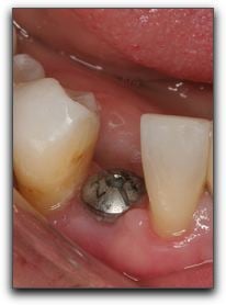 Beverly Hills Tooth Implants