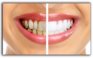 Teeth Whitening For 3 Types of Tooth Stains in Los Angeles