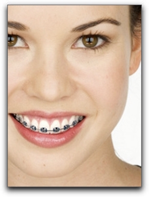 Invisalign Treatment For Los Angeles Patients