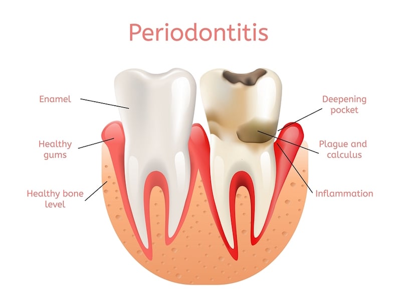 prevent gum disease Los Angeles