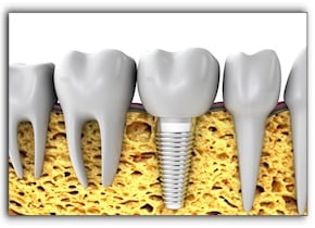 Hollywood tooth implants Missing Teeth in Century City