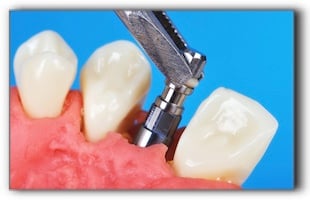 dental implant cost Hollywood