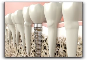 Los Angeles dental implants