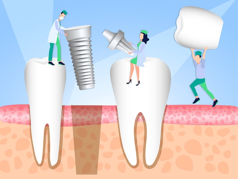 a tooth implant timeline Los Angeles