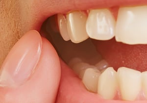 inflamed gums Los Angeles