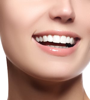 porcelain veneers Los Angeles