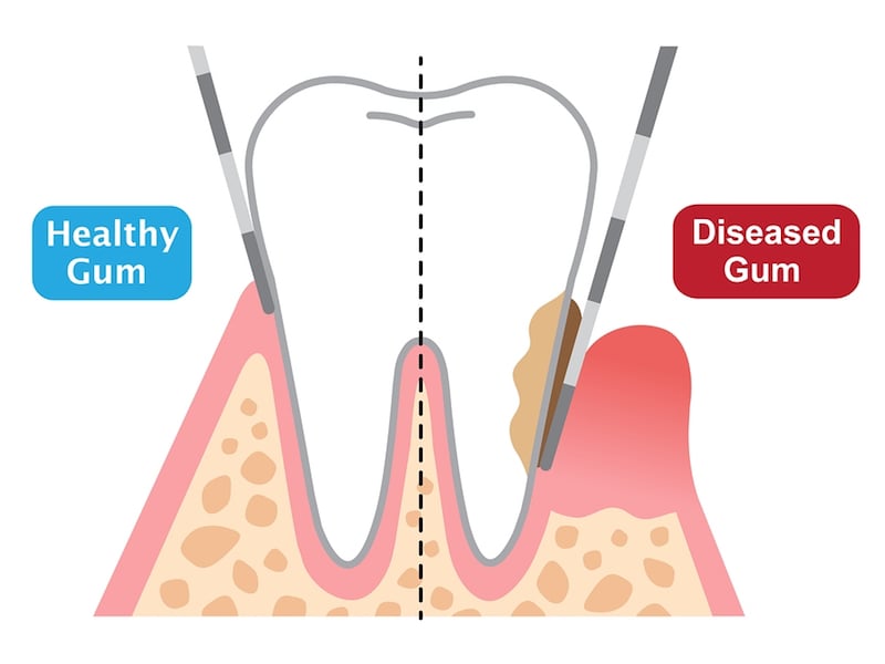 gum disease treatment Los Angeles