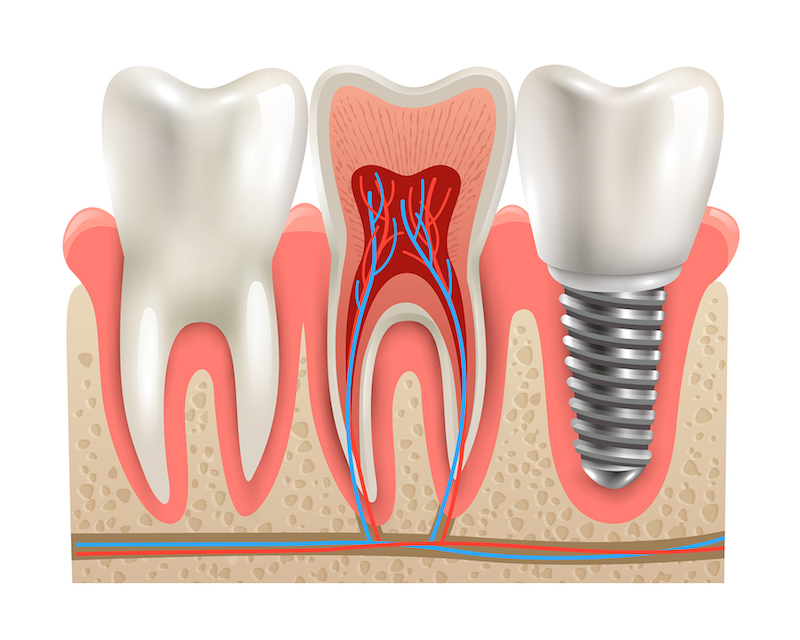 dental implants Los Angeles Missing Teeth in Los Angeles