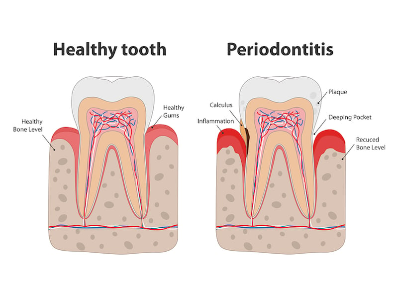 treatment for bleeding gums Hollywood