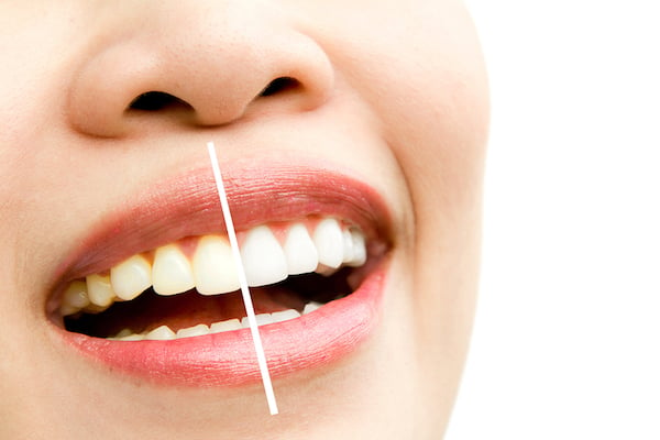 teeth whitening Los Angeles Teeth Whitening in Los Angeles