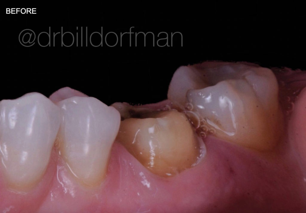 before porcelain crown from bill dorfman in los angeles