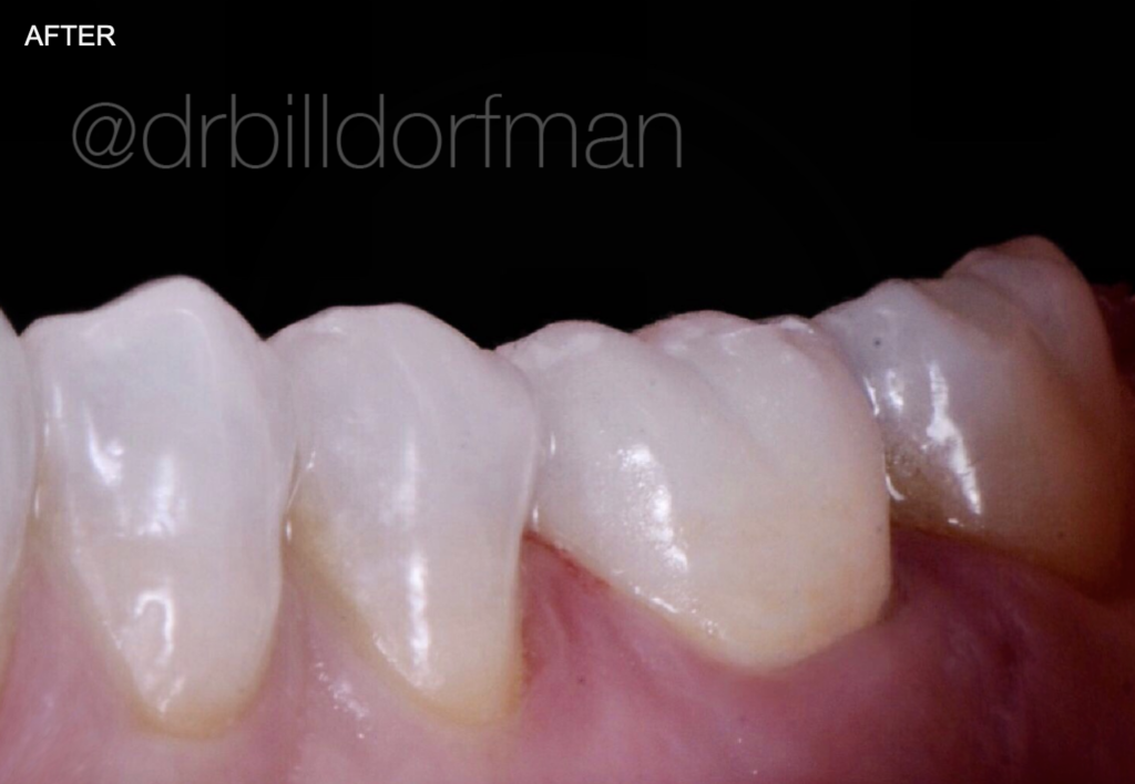 after porcelain dental crown from bill dorfman in los angeles