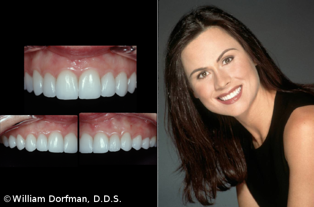 Before and after porcelain veneers from Beverly Hills dentist Dr. Bill Dorfman