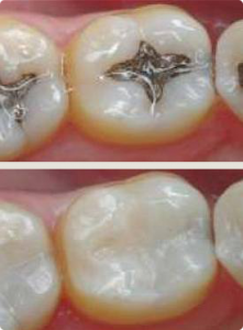 Tooth colored fillings vs metal fillings from patient in Santa Monica