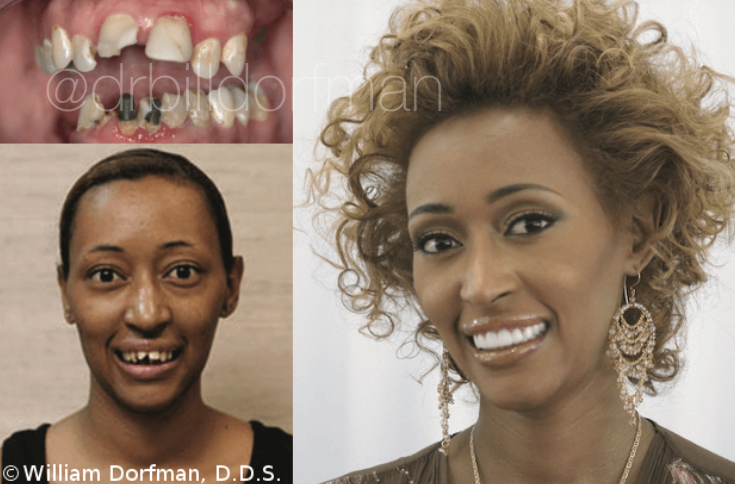 Upper Bridge & Upper And Lower Porcelain Veneers