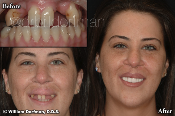 Partial Denture and Porcelain Veneers