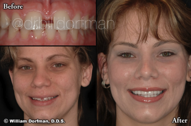 8 Upper Porcelain Veneers