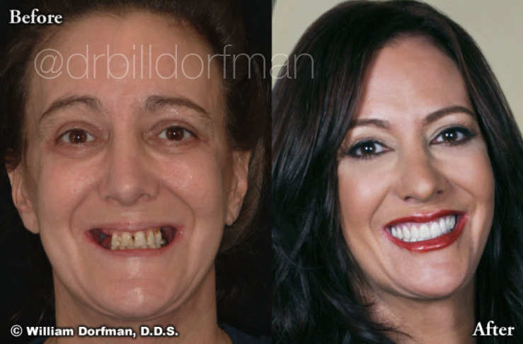 5 Upper Porcelain Veneers & Partial Denture