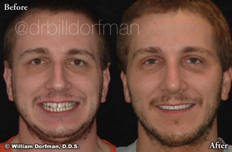 8 Upper Porcelain Veneers