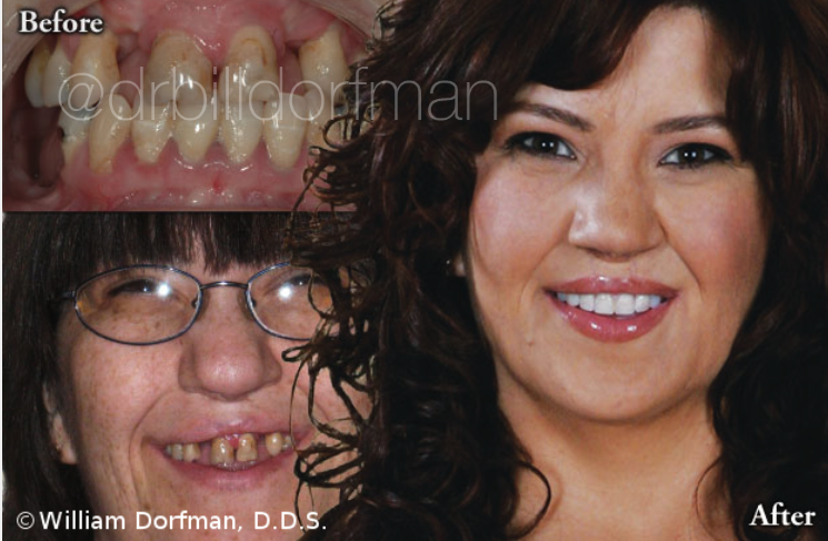 Dentures Before and After Photo