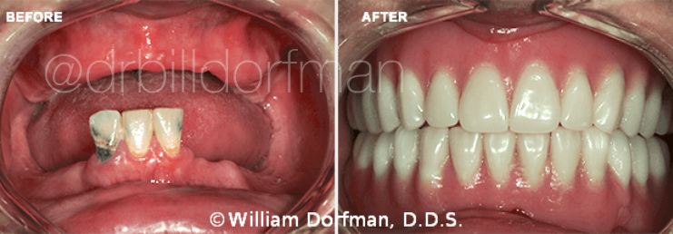 Dentures Before and After Photo