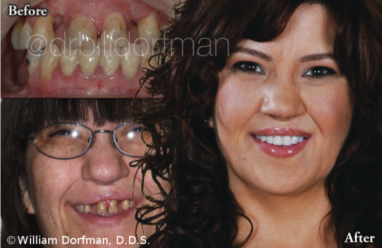 Partial Denture & Porcelain Veneers