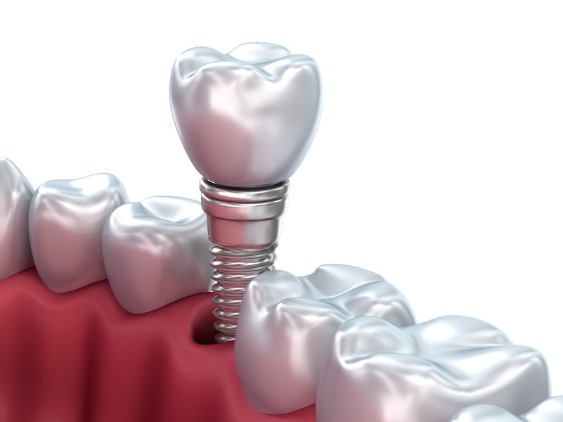 Dental Implants Los Angeles