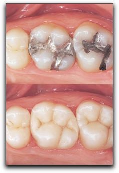 Tooth Colored Fillings In Beverly Hills