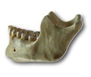 Los Angeles Jaw Bone Deterioration