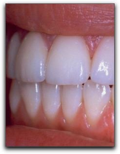 Porcelain Veneers Los Angeles