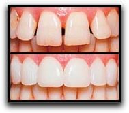 Los Angeles Prepless Veneers