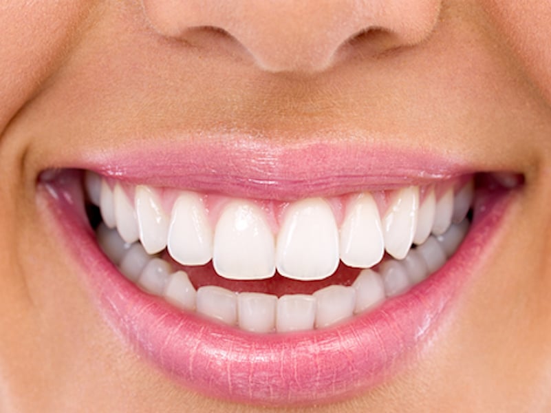 Professional Teeth Whitening In Los Angeles