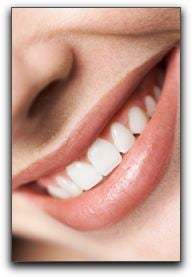 Porcelain Veneers