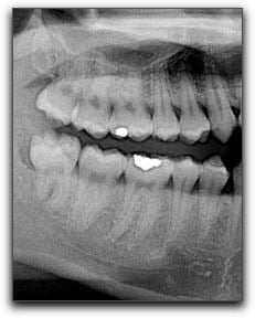 Wisdom Teeth And Your Los Angeles Dentist