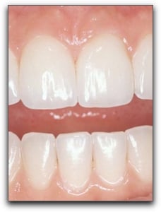 Los Angeles Professional Teeth Whitening