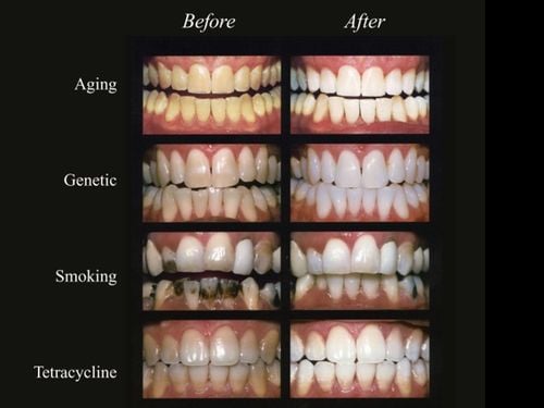 Whitening Before After