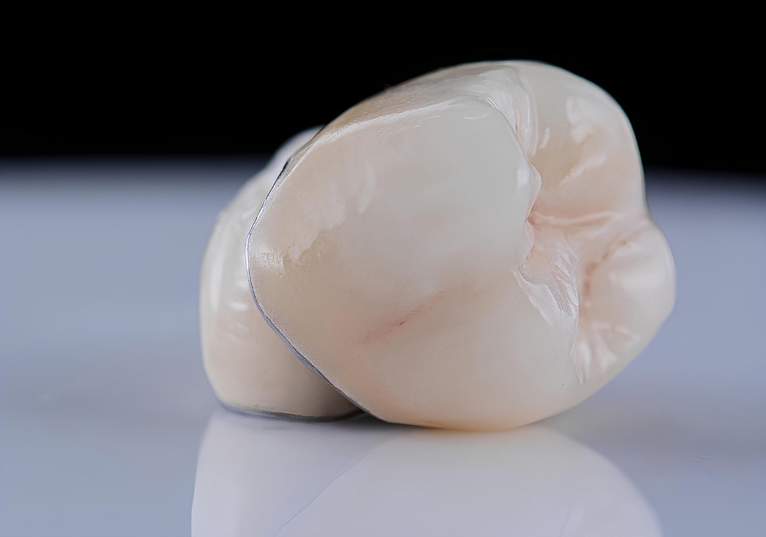 porcelain veneers and crowns used in smile design treatment in Los Angeles