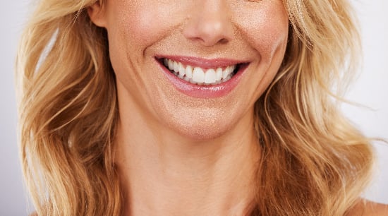 closeup of lower half of woman's face, dental veneers