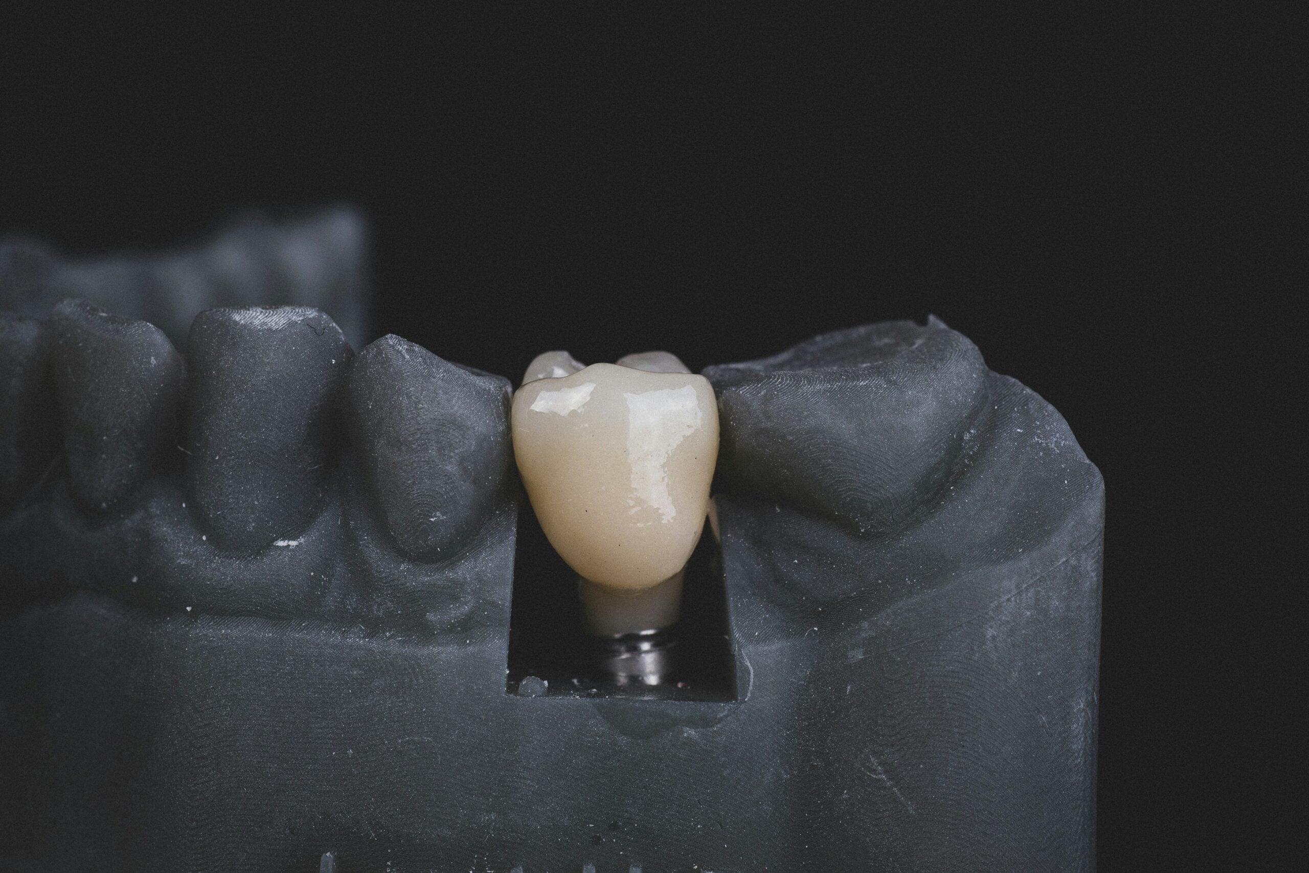 Single tooth dental implant — Dr. Bill Dorfman, Los Angeles