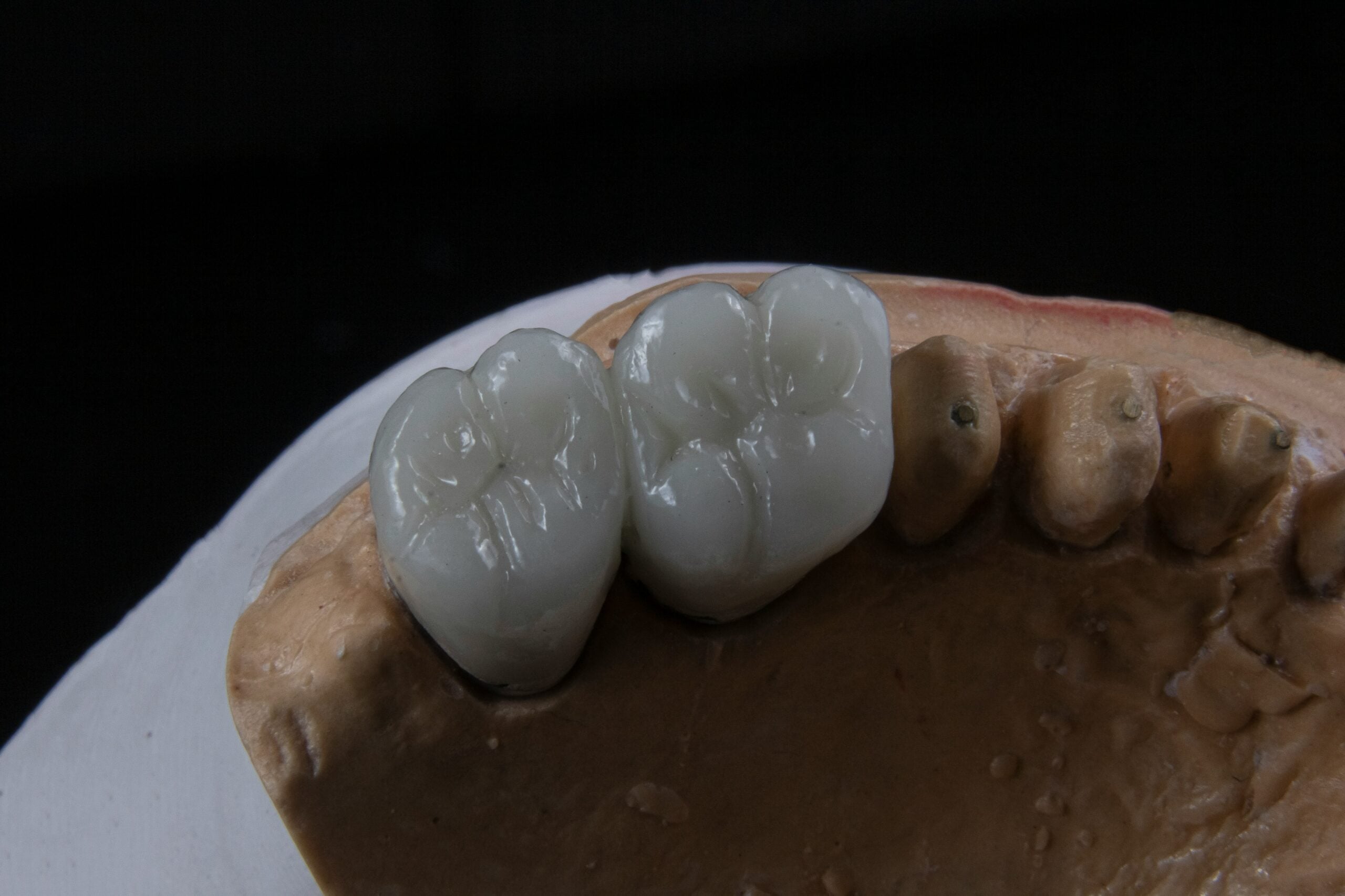 multiple tooth dental implants - Dr Bill Dorfman, Los Angeles