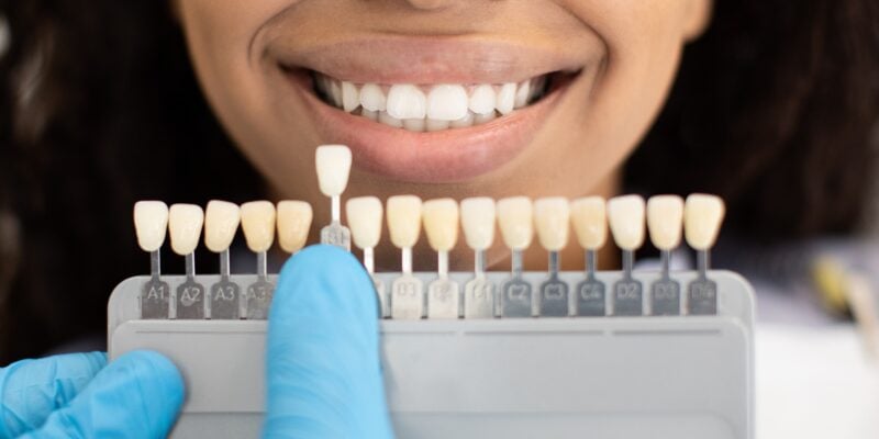 closeup of a woman smiling, set of dental veneers in the front