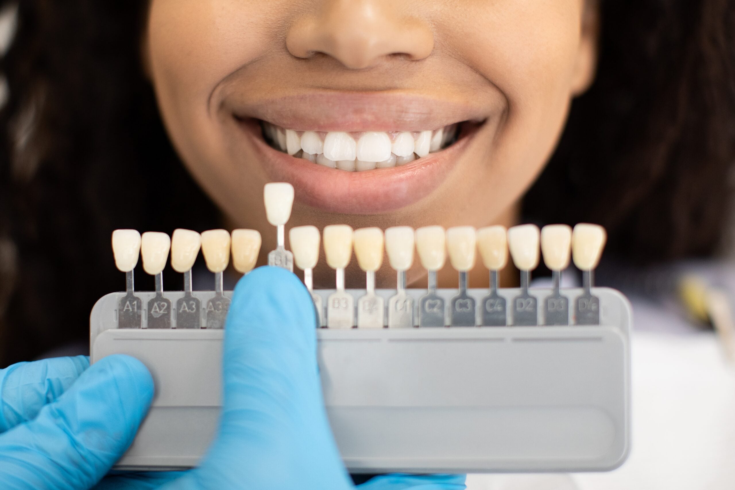 closeup of a woman smiling, set of dental veneers in the front