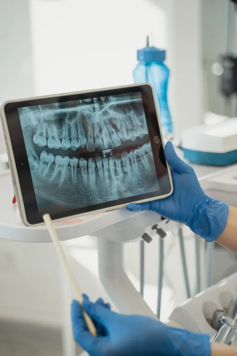los angeles implant dentures dentist showing patient x-ray