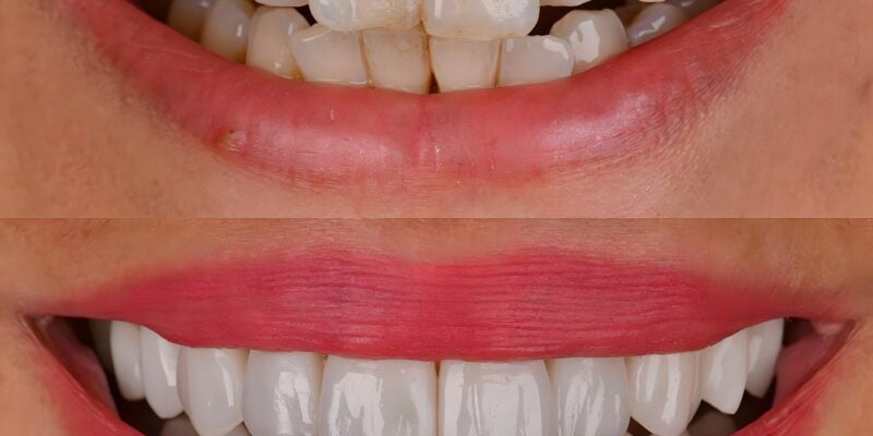 closeup, side by side of a smile makeover, before and after